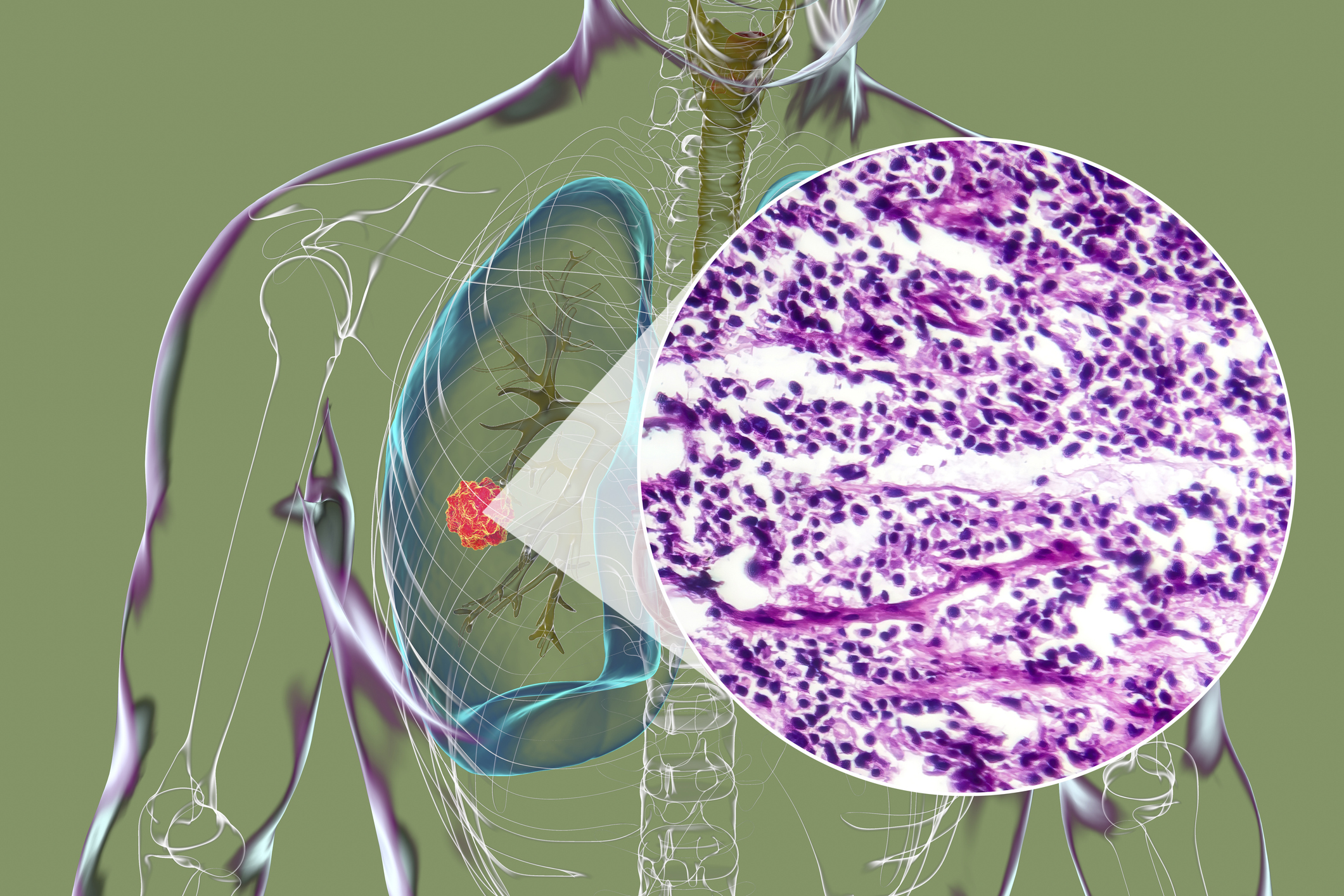 A human body with transparent skin showcasing lung cancer, 3D illustration complemented by a light micrograph of the small cell lung cancer.