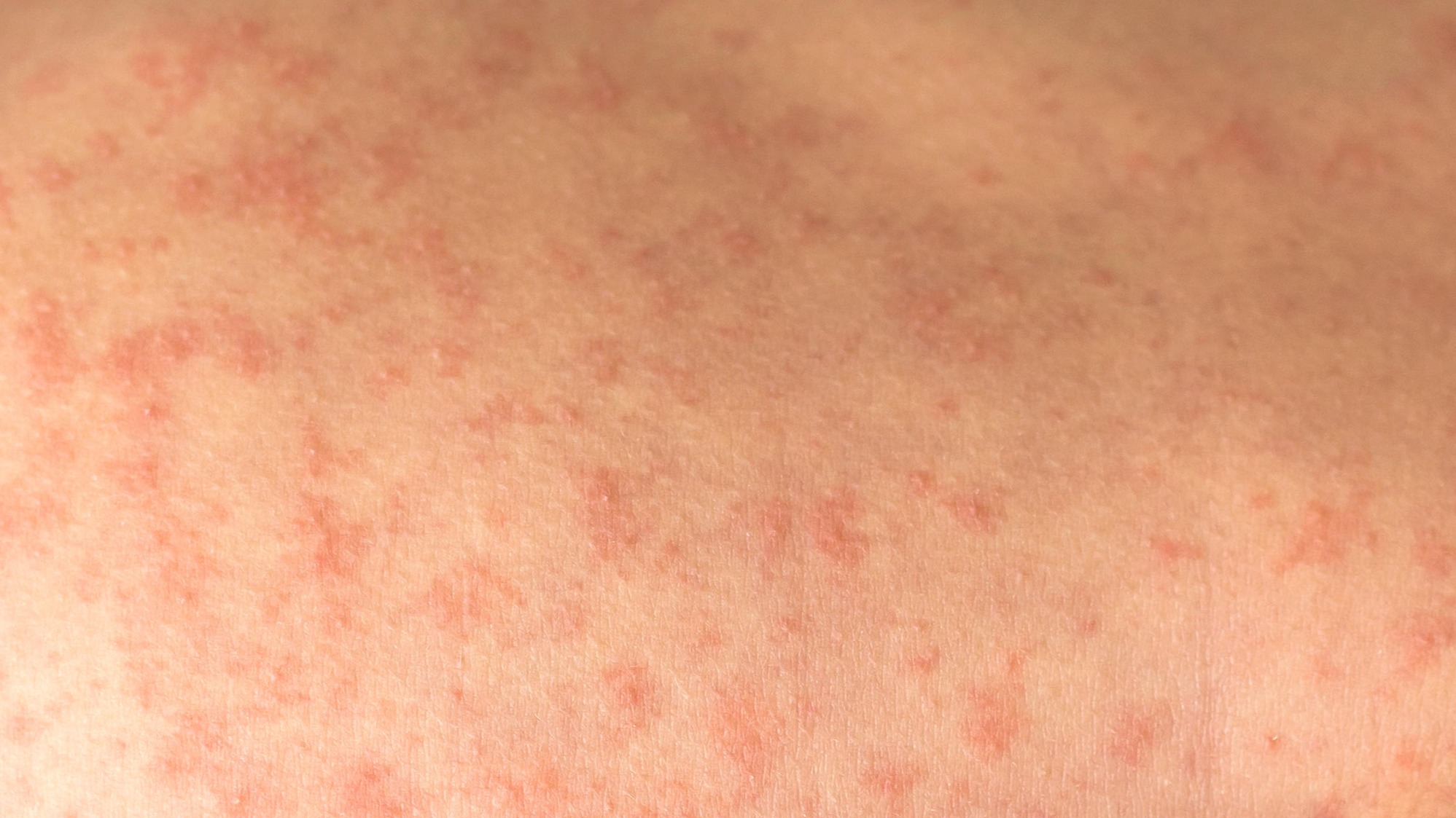 Image of measles rash on the stomach.