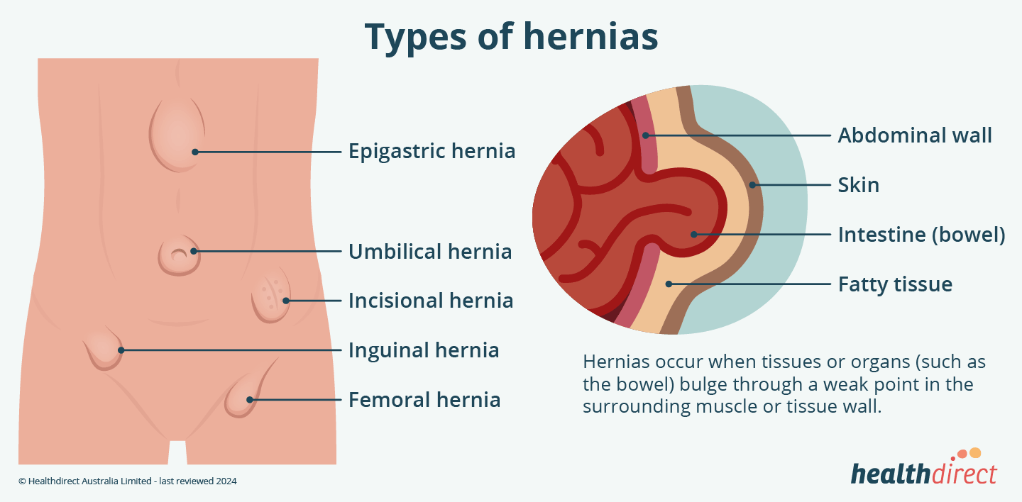 Illustration showing the locations of hernias (left) and the inside of a hernia where the bowel has pushed through the abdominal wall (right).