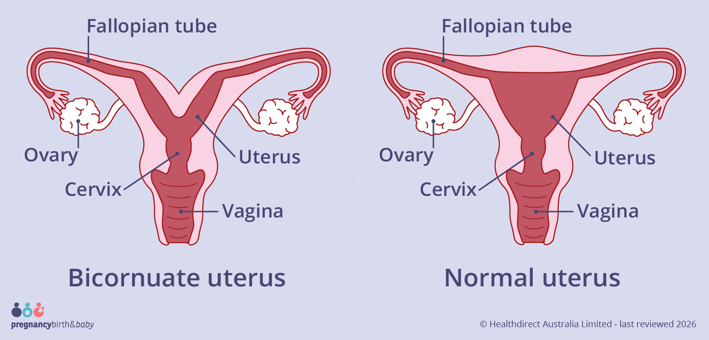 A bicornuate uterus has a deep indentation at the top of the uterus.