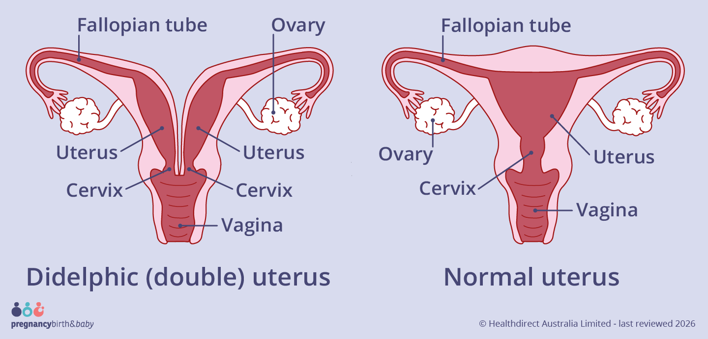 A didelphic uterus is split into two separate halves, each with its own uterus (womb) and cervix. Both cervixes lead into one vagina.