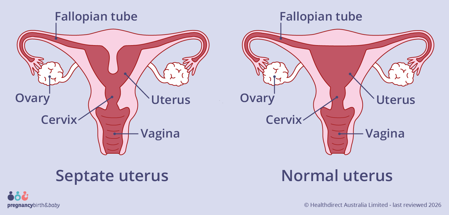 A septate womb has a wall of muscle that comes down the centre of the uterus and splits the uterus into two areas.