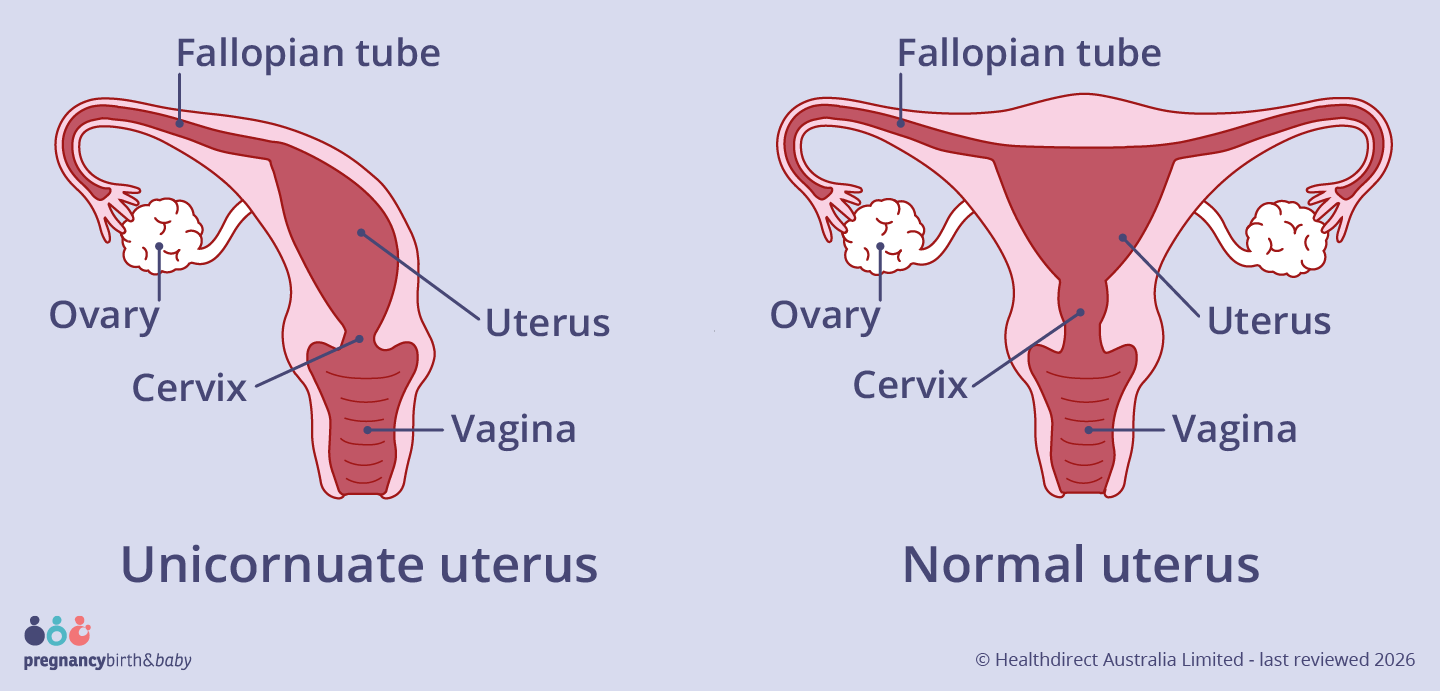 A unicornuate uterus is about half the usual size. It has one narrow cavity that curves to one side, with one fallopian tube and one ovary.