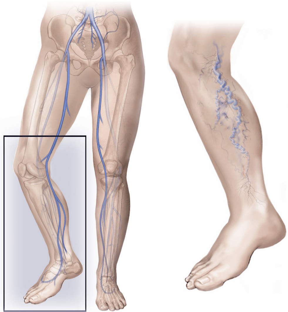 Illustration showing varicose veins.