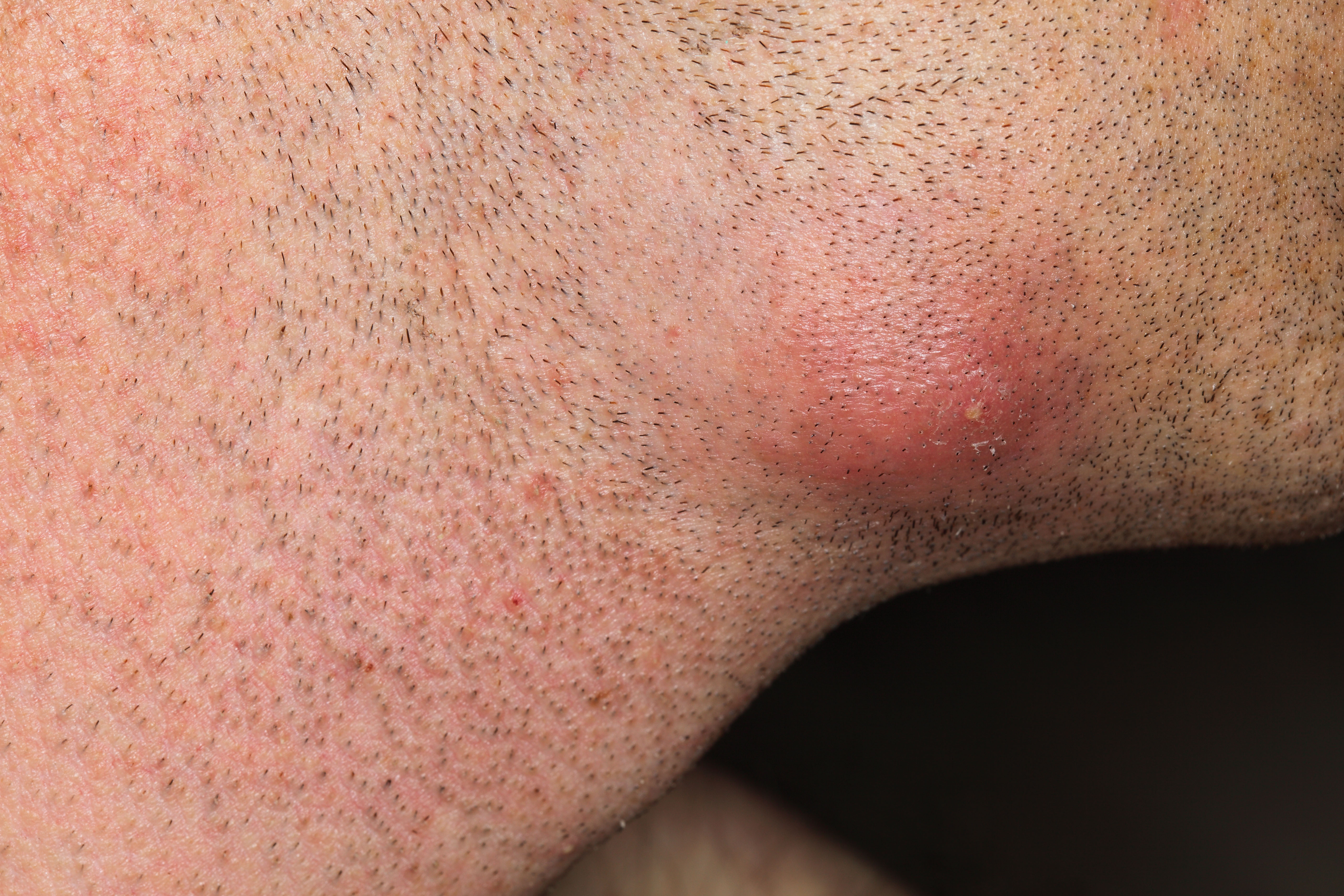 A photo showing a boil thats formed on a persons jawline
