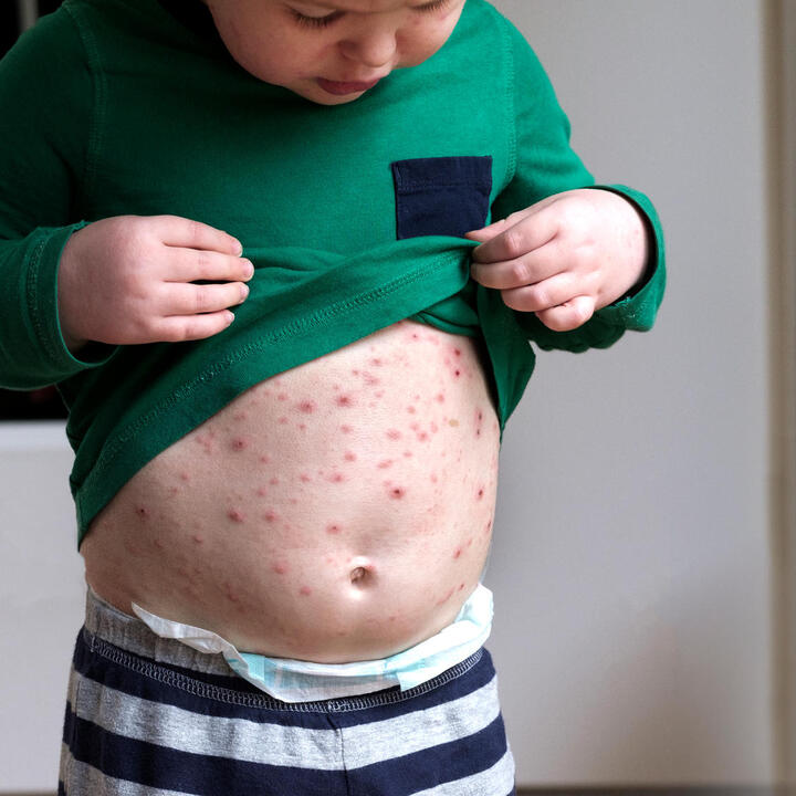 Image of chickenpox on skin.