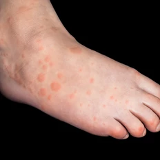 Hand, foot and mouth disease on a child's foot