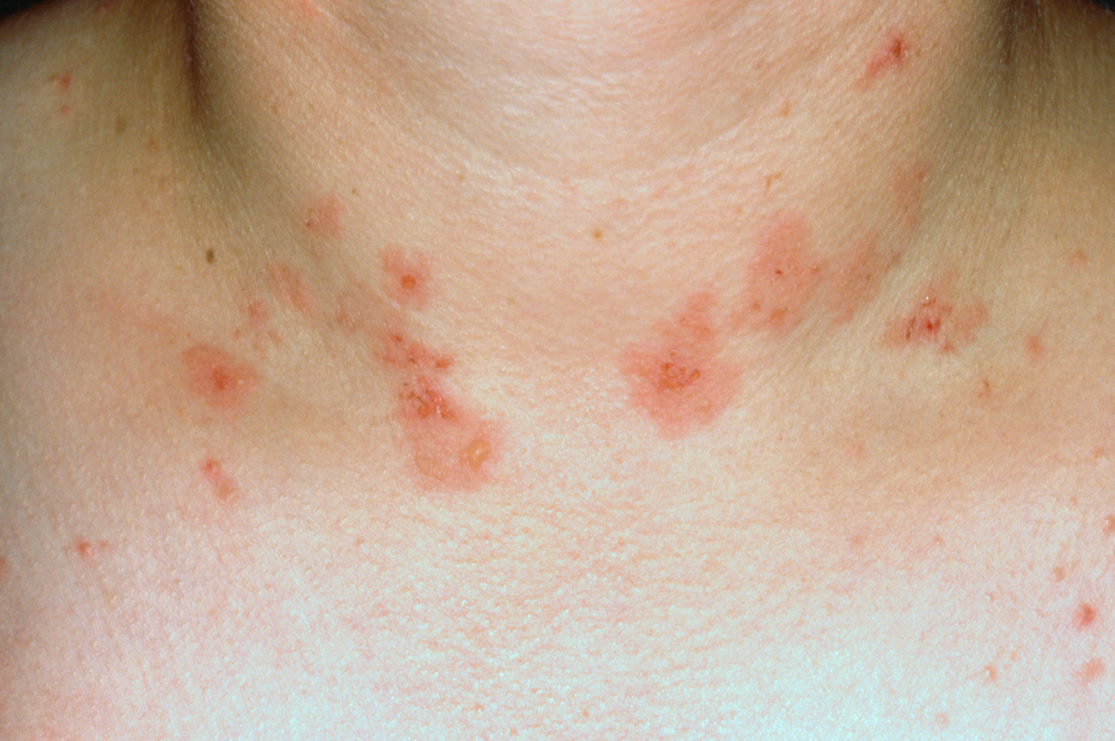 Image of dermatitis herpetiformis on the skin around the neck.