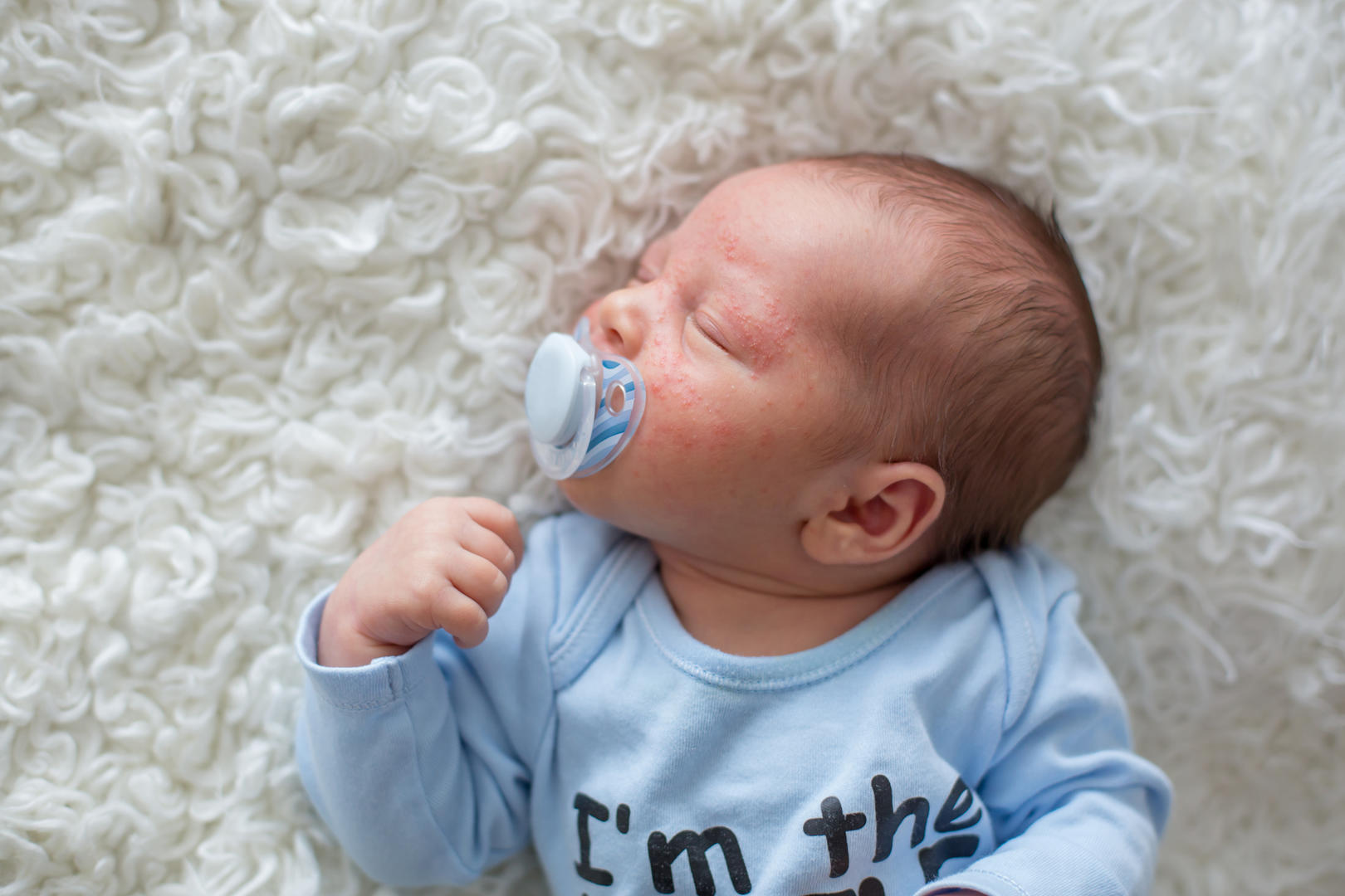 Image of a baby with eczema on their face.