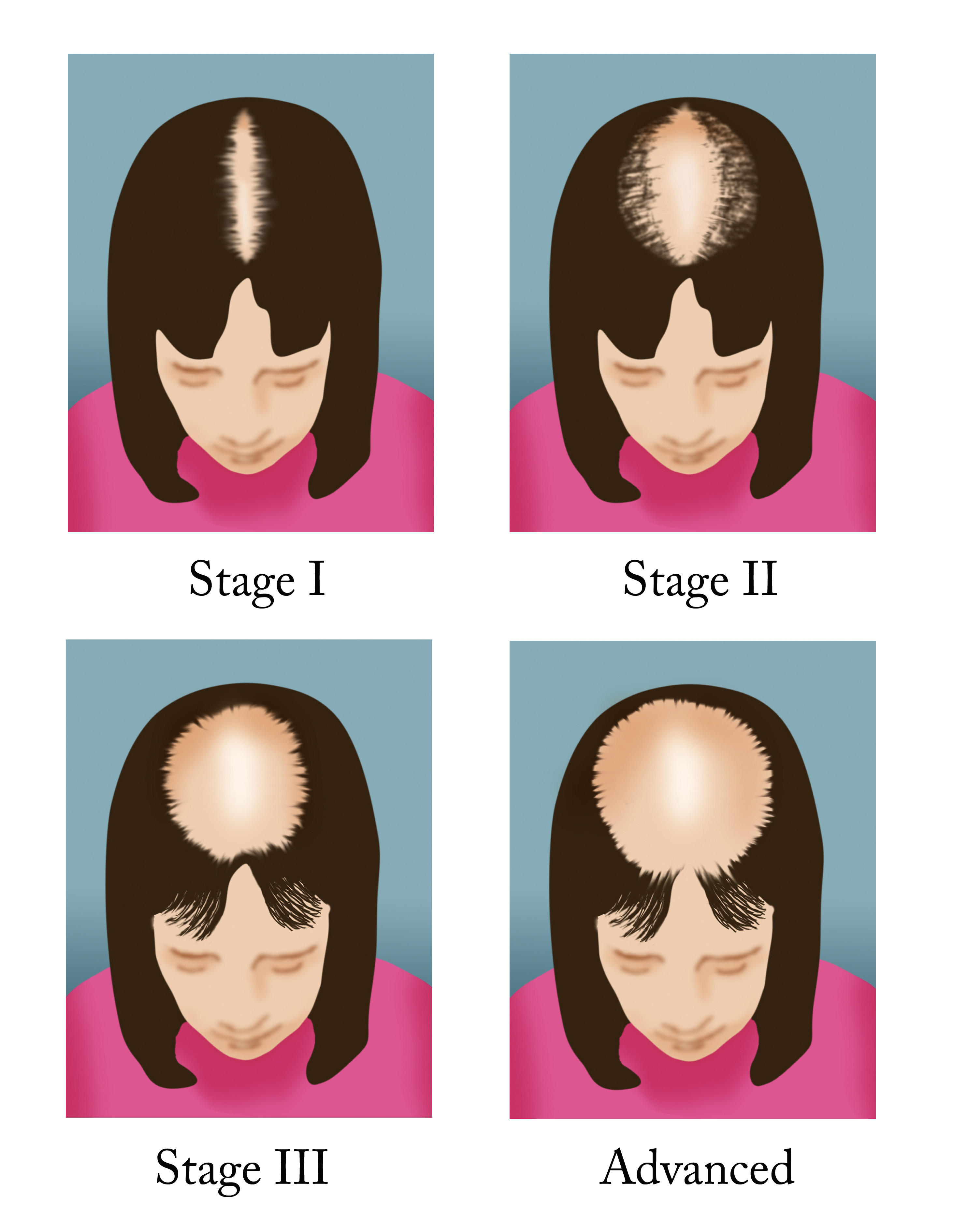 Illustration of the four stages of female pattern hair loss