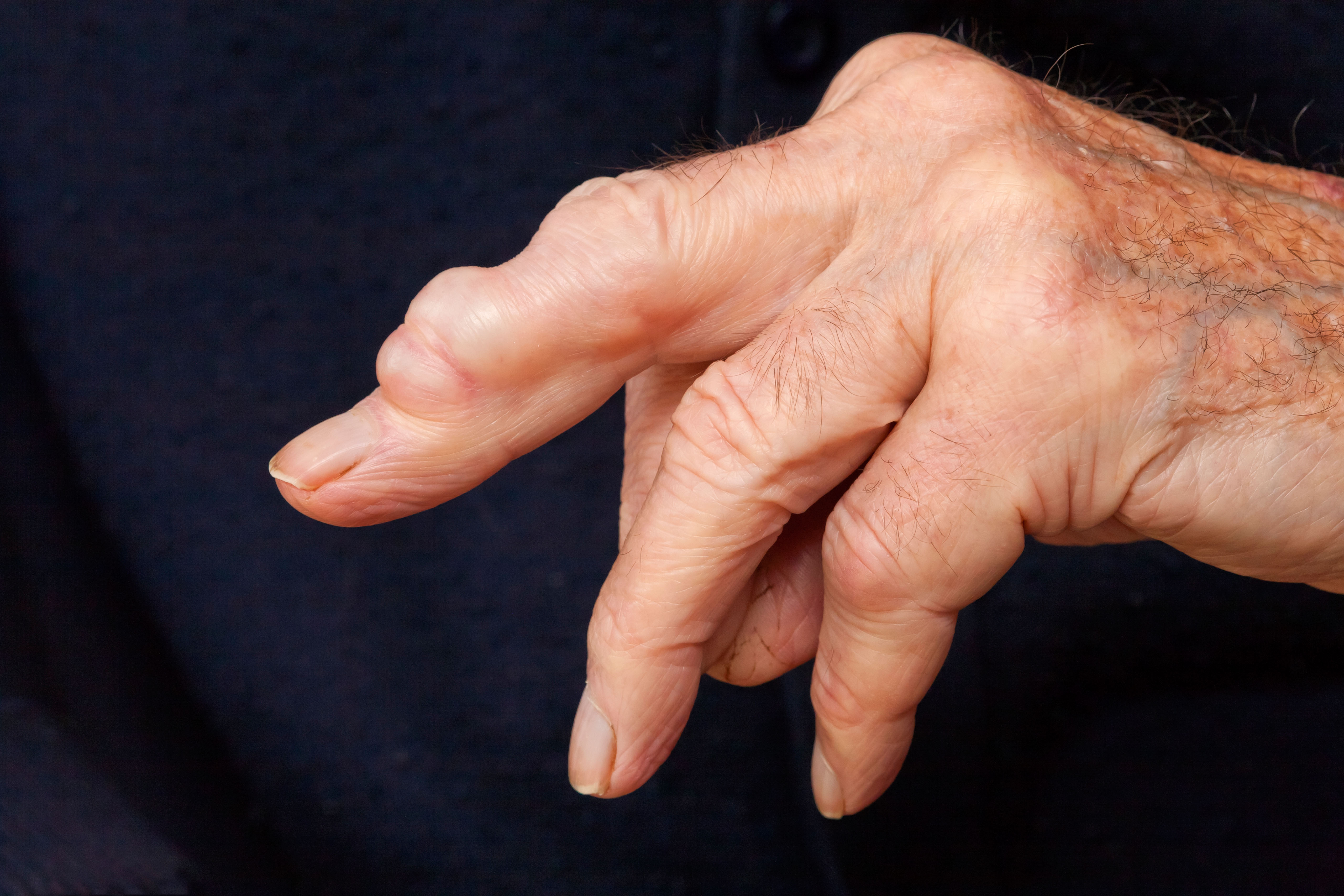 Image of a Ganglion cyst