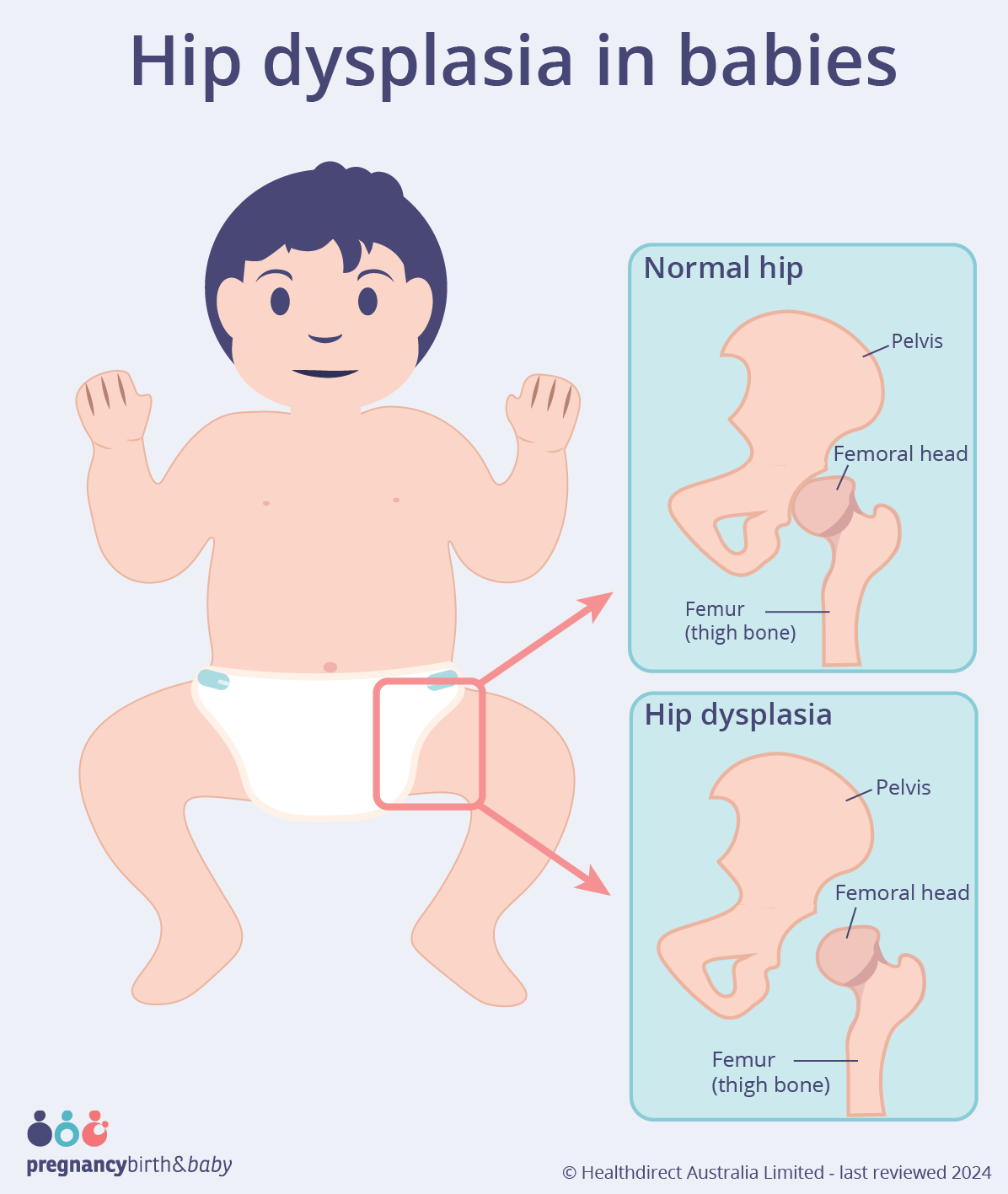 Illustration showing hip dysplasia.