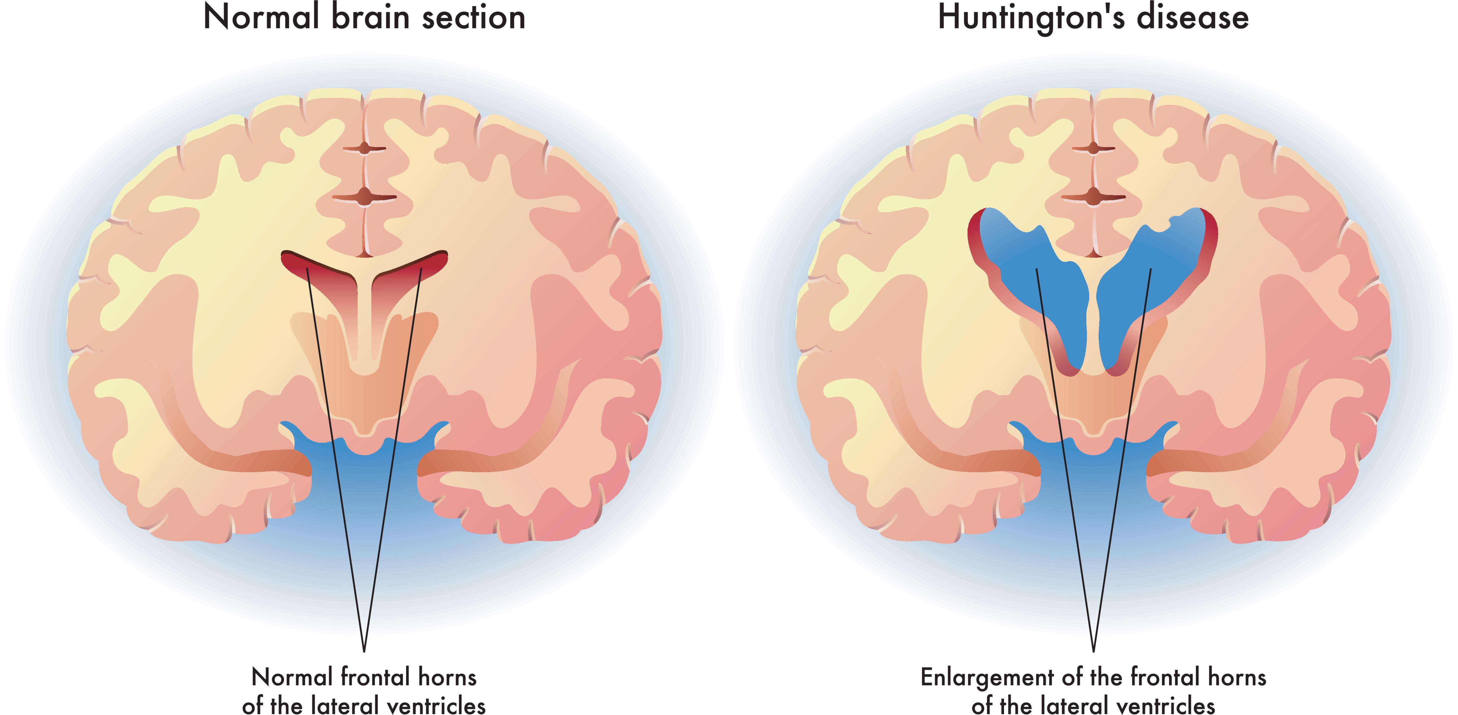 Illustration showing the difference in structure of a normal brain and one with Huntington's disease.