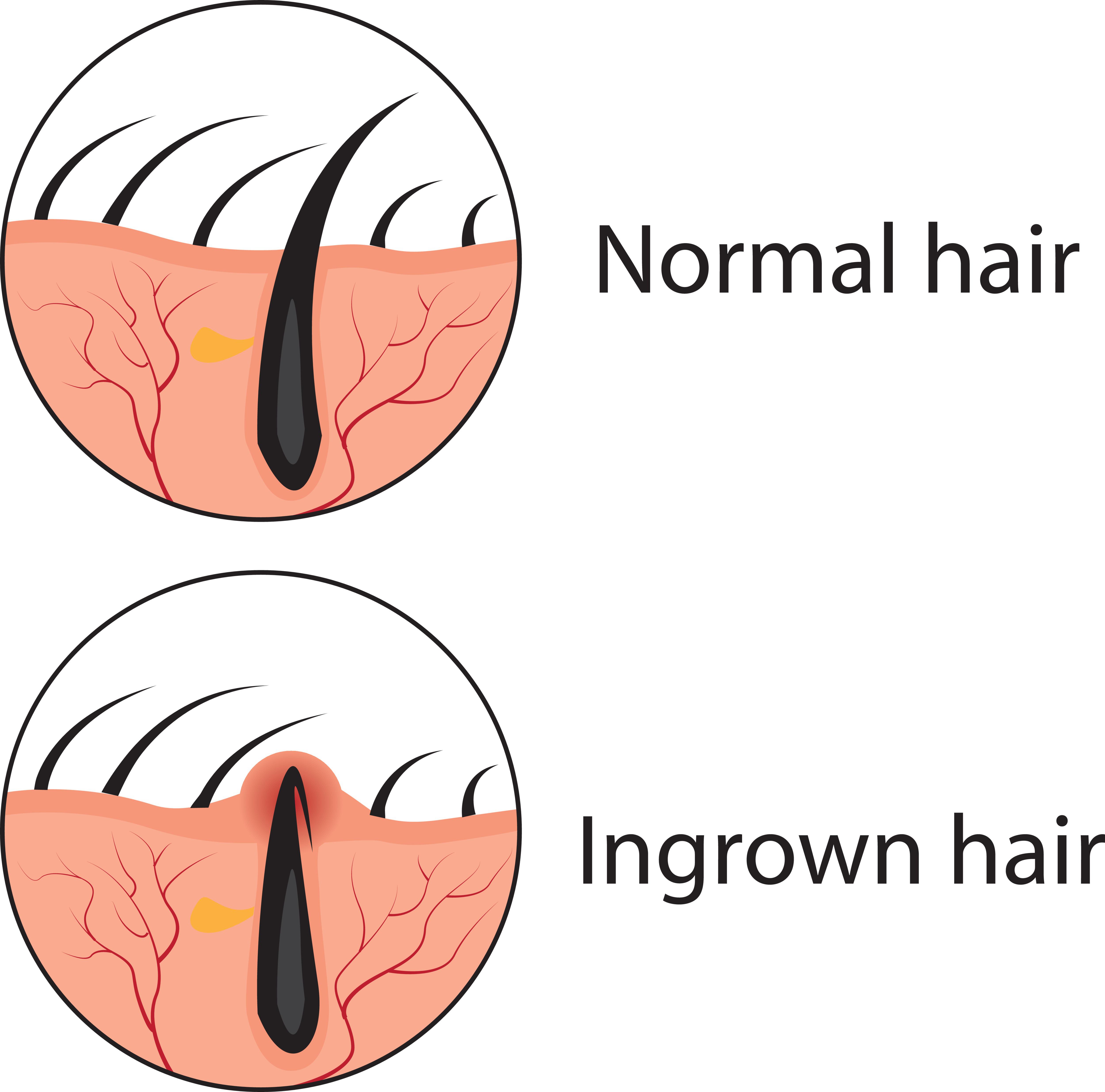 Illustration of an ingrown hair compared to normal hair.