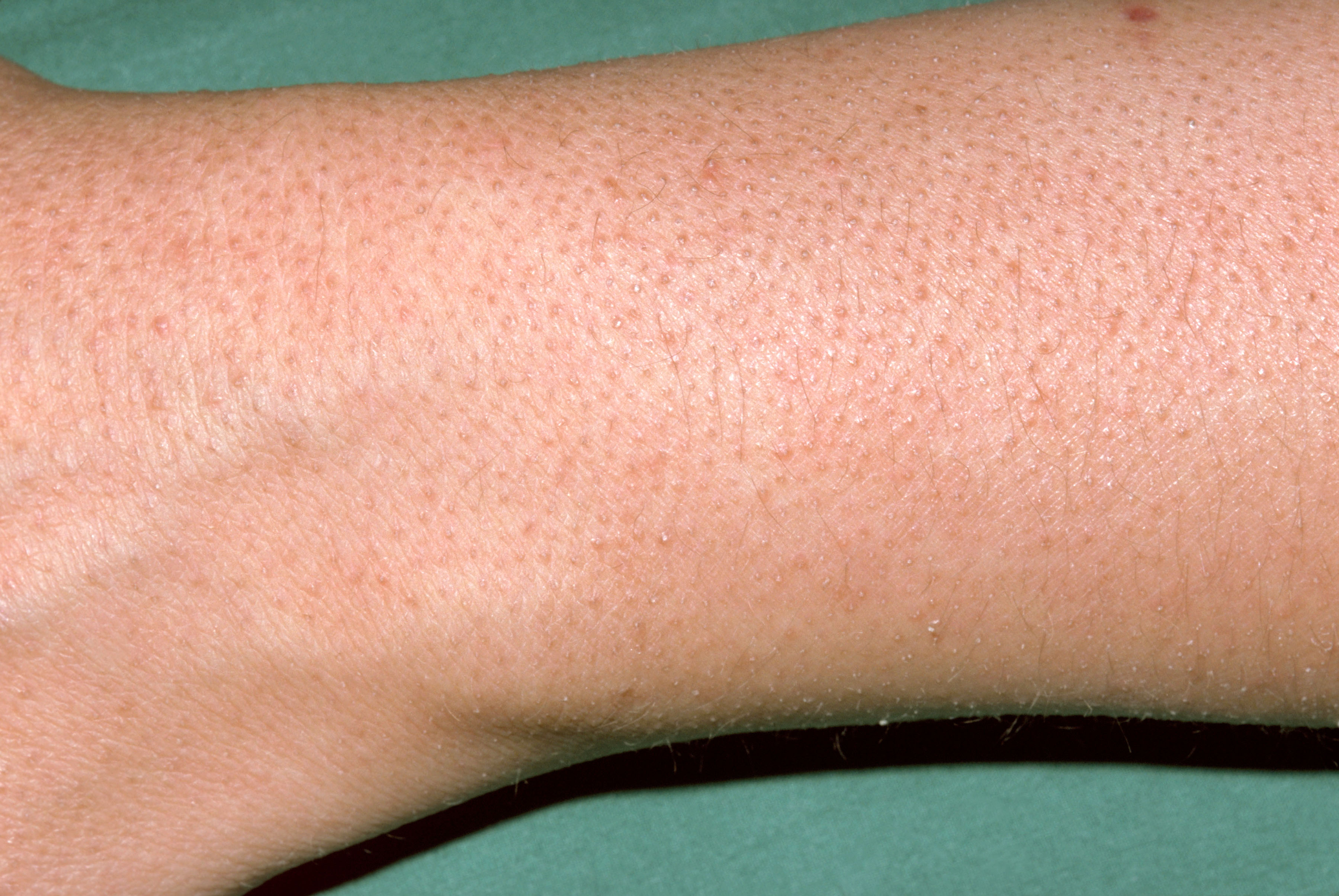 Photo showing keratosis pilaris on the forearm.