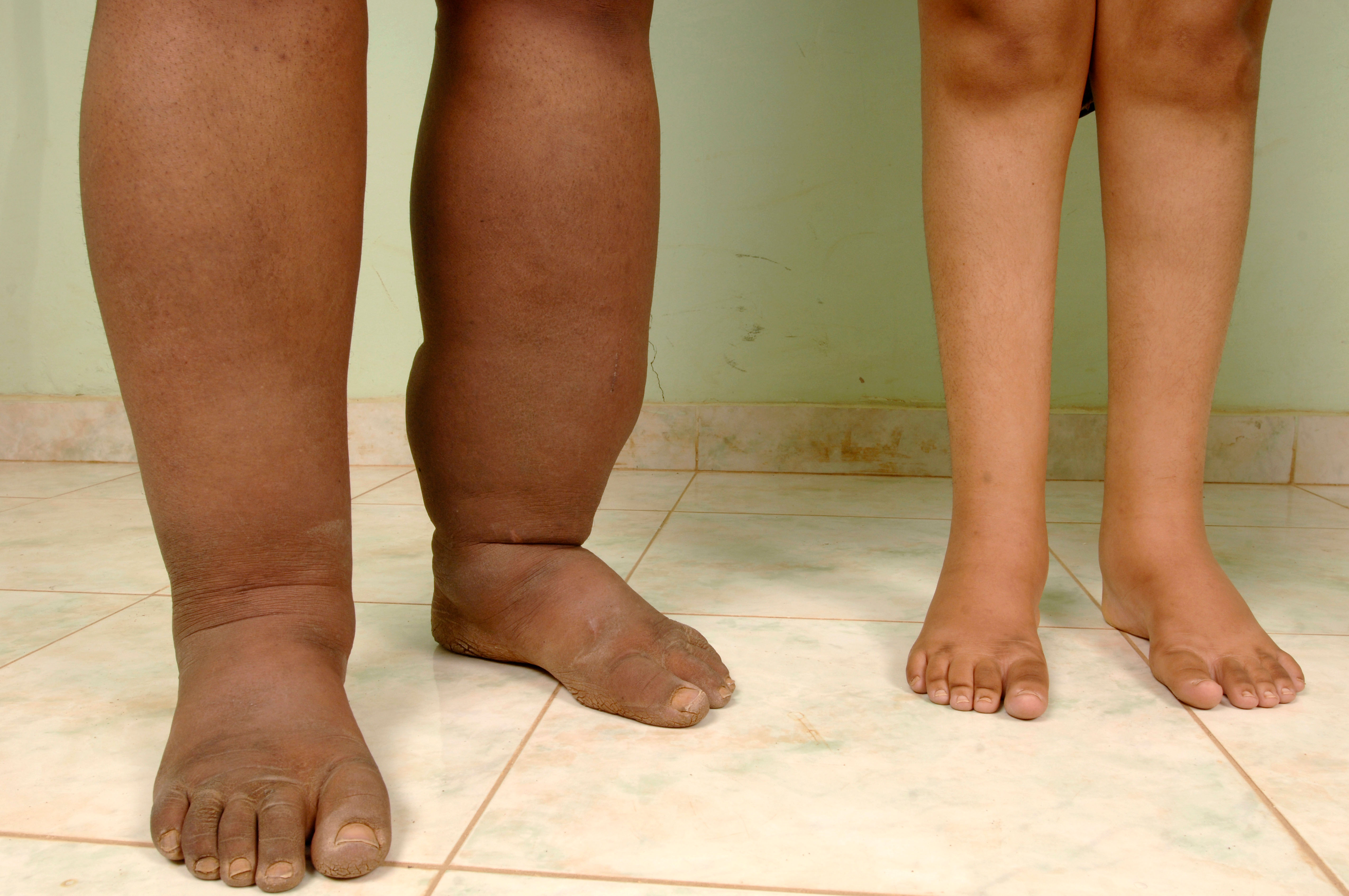 Image showing lymphodoema swelling in legs.