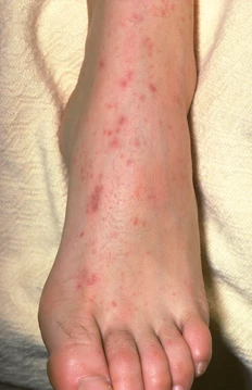 meningococcal on a foot