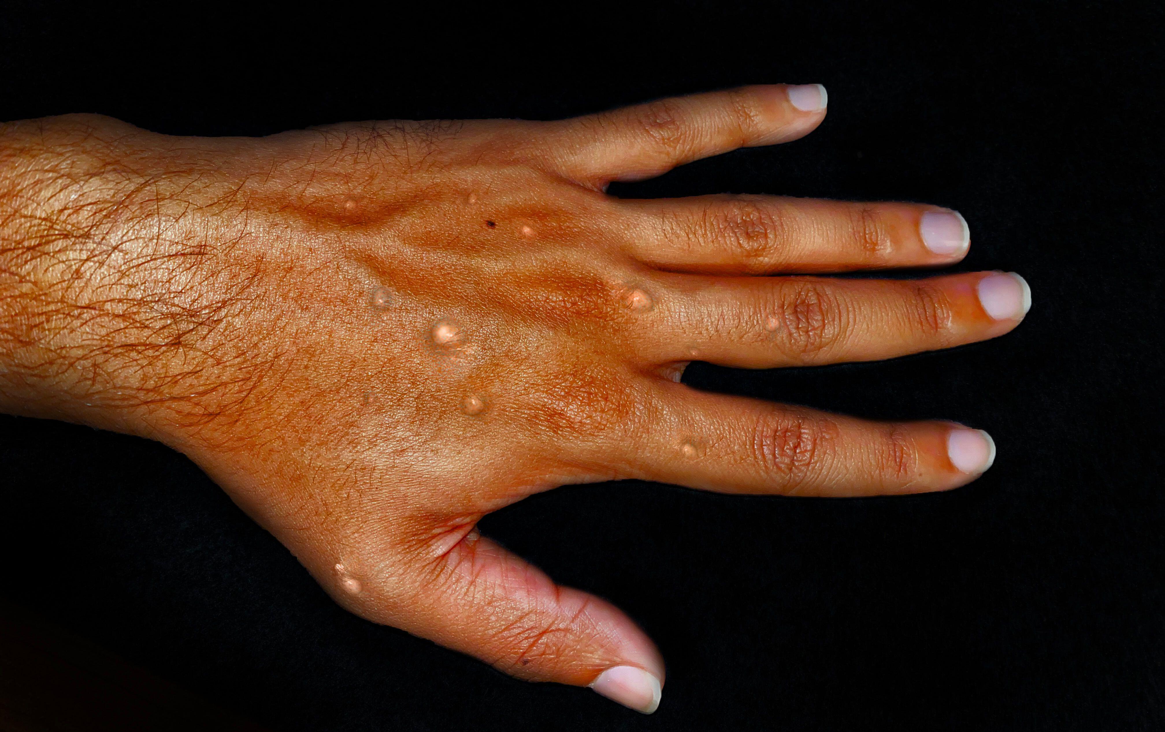 Monkeypox blisters on a hand