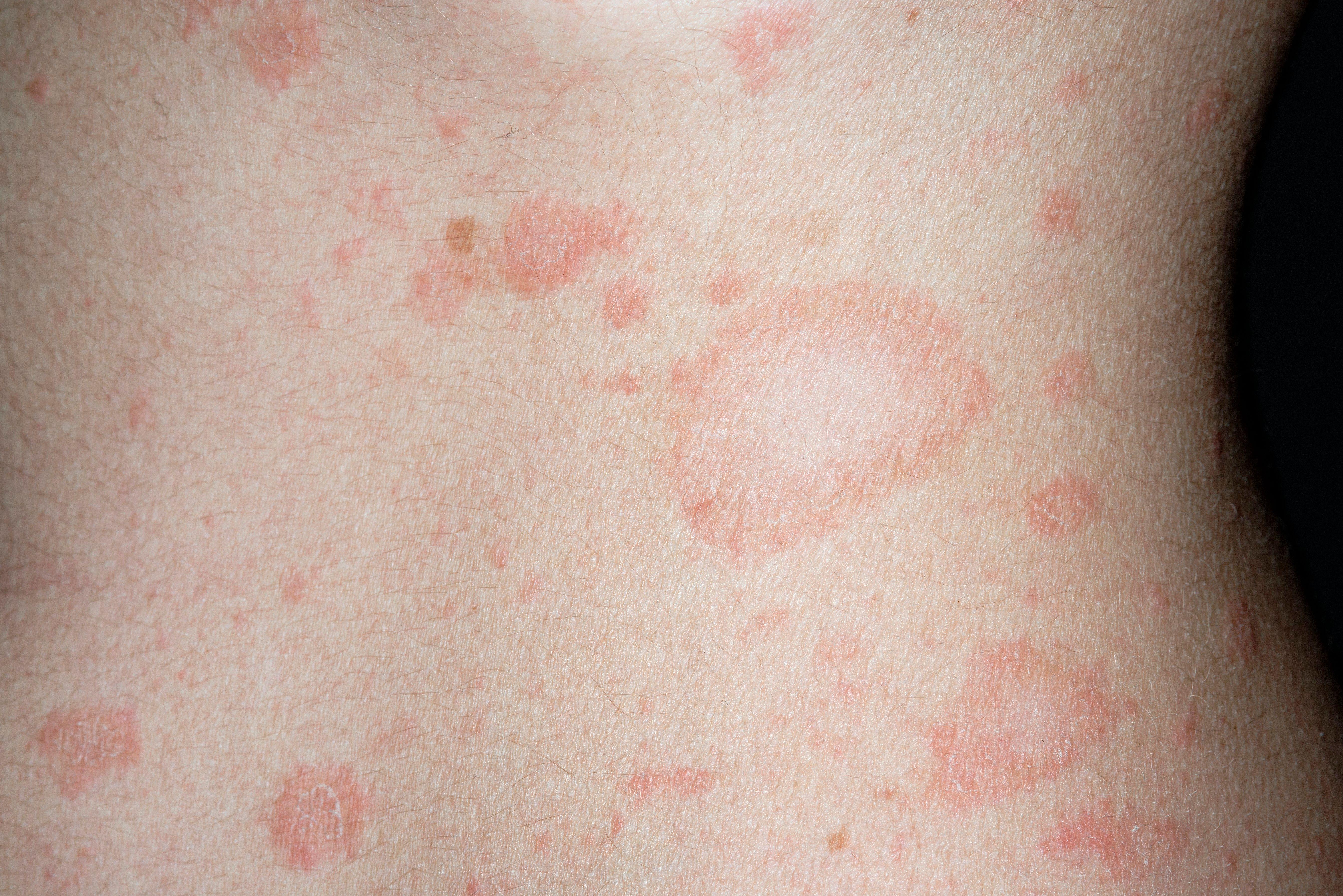 Pityriasis rosea on a person's abdomen