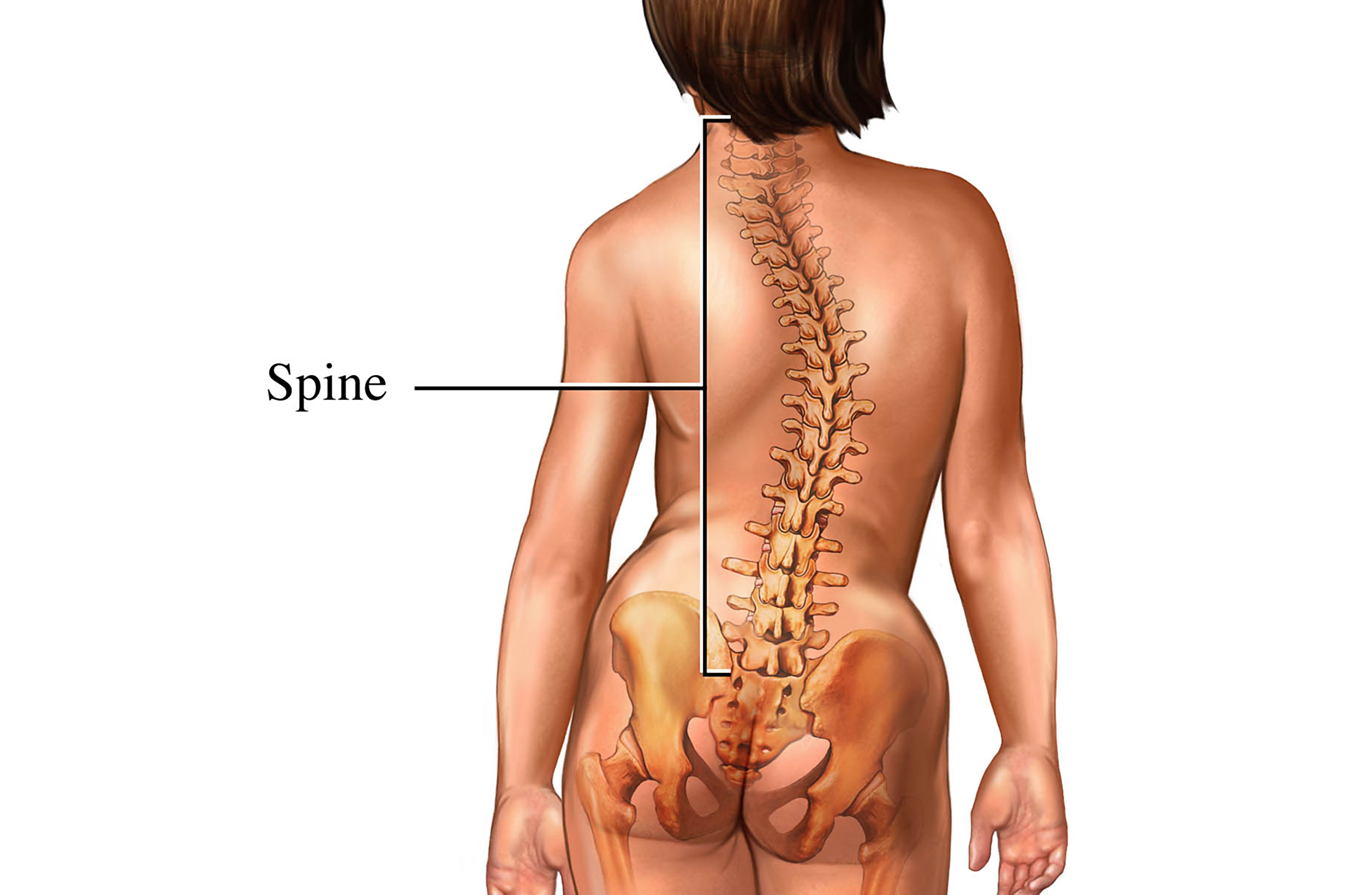 Illustration showing an example of scoliosis.