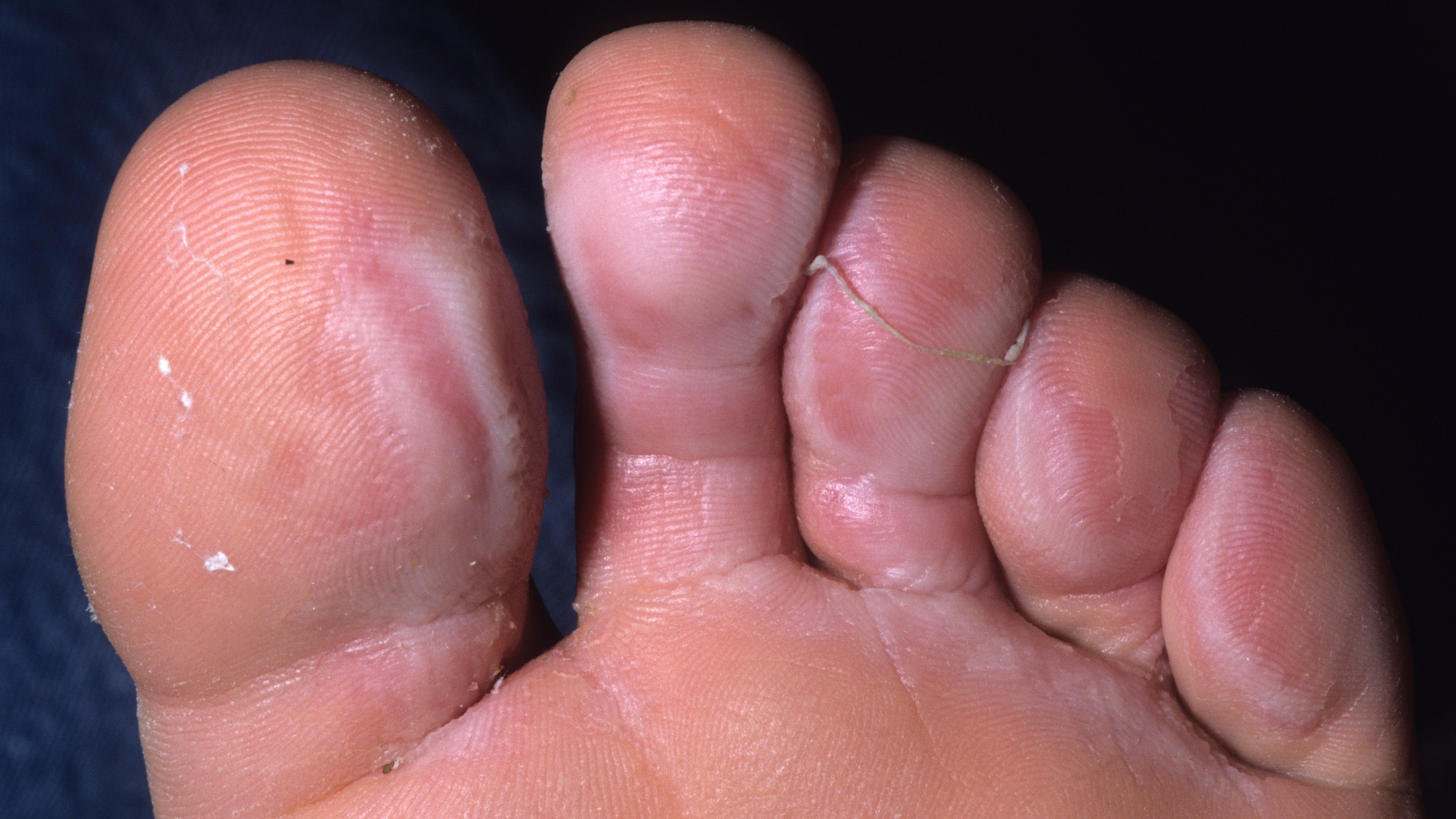 Athlete's foot
